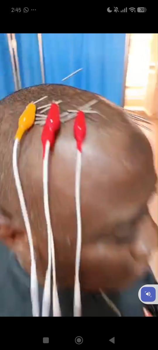 Acupuncture Session