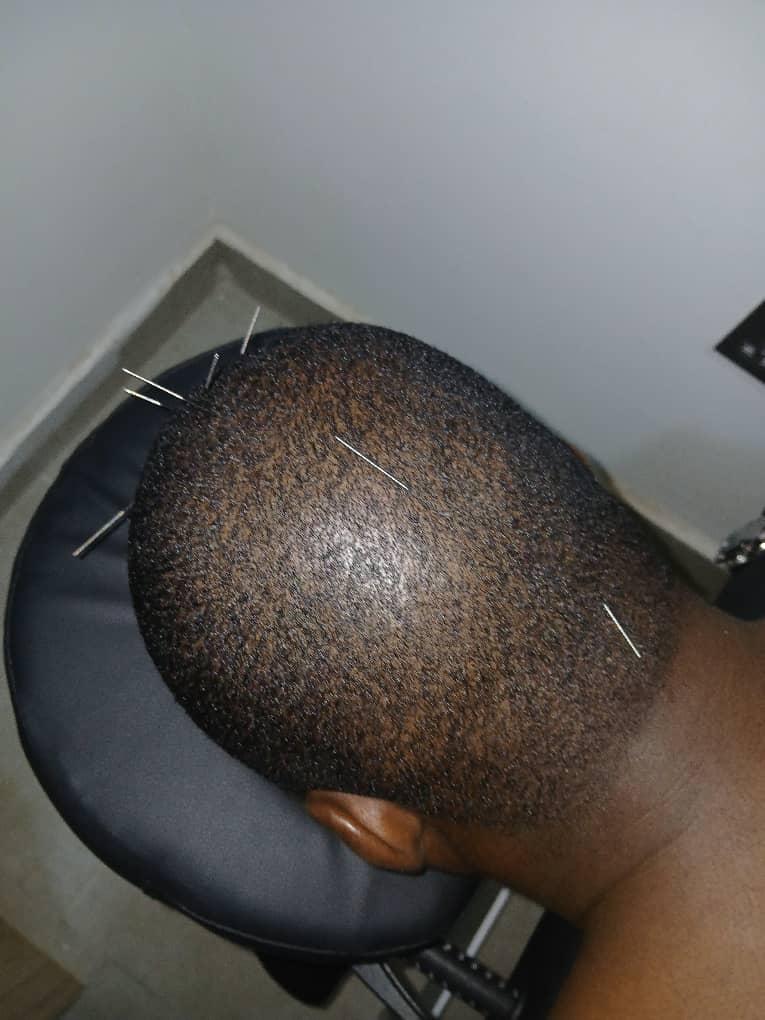 Scalp Acupuncture Session